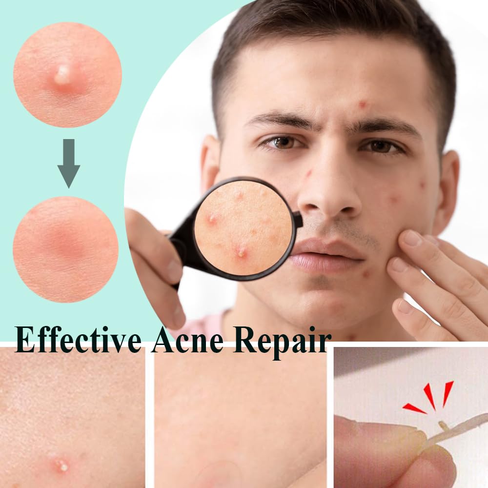 Zemolo 300pcs Pimple Patches Hydrocolloid Acne Stickers with Tea Tree Oil Spot Cover Patches Day & Night Whiteheads Acne Absorbing Blemish Patches Invisible Spot Treatment Stickers