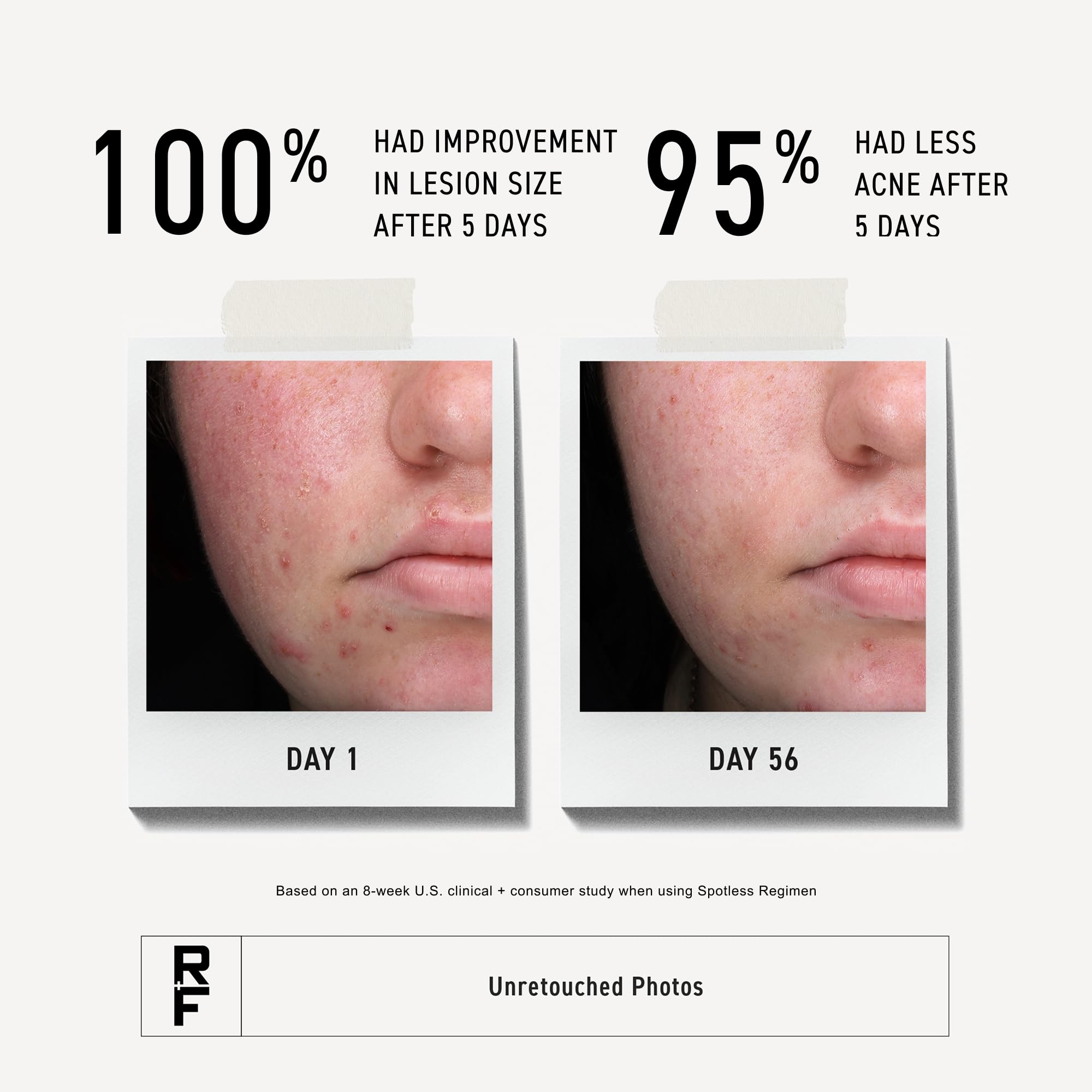 Rodan + Fields Spotless Regimen | Skincare Kit - 60-day Supply
