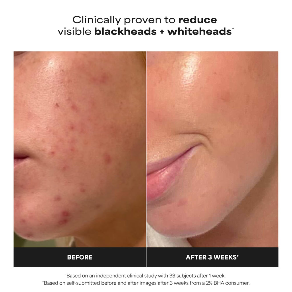 Paula's Choice SKIN PERFECTING 2% BHA Liquid Exfoliant, 5 Fl Oz (Pack of 2)