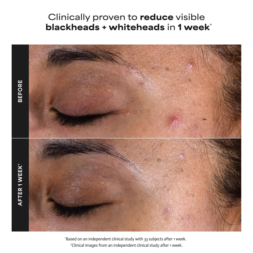 Paula's Choice SKIN PERFECTING 2% BHA Liquid Exfoliant, 5 Fl Oz (Pack of 2)