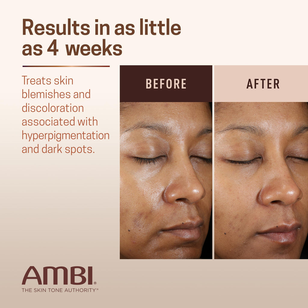 Ambi Even & Clear Advanced Fade Cream, Hydroquinone-free, Hyperpigmentation Treatment, Stubborn Dark Spot Corrector, Results In As Little As 2-3 Weeks, Niacinamide, Licorice Root Extract, PHA, 1 Fl Oz